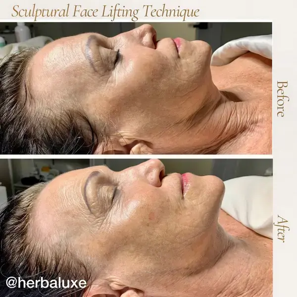 Before and after, Sculptural Face Lifting