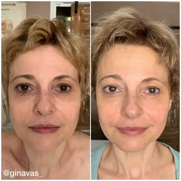 Before and after, Sculptural Face Lifting